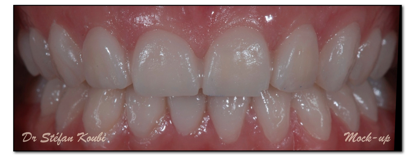 veneers and crowns /Dr Stefan Koubi